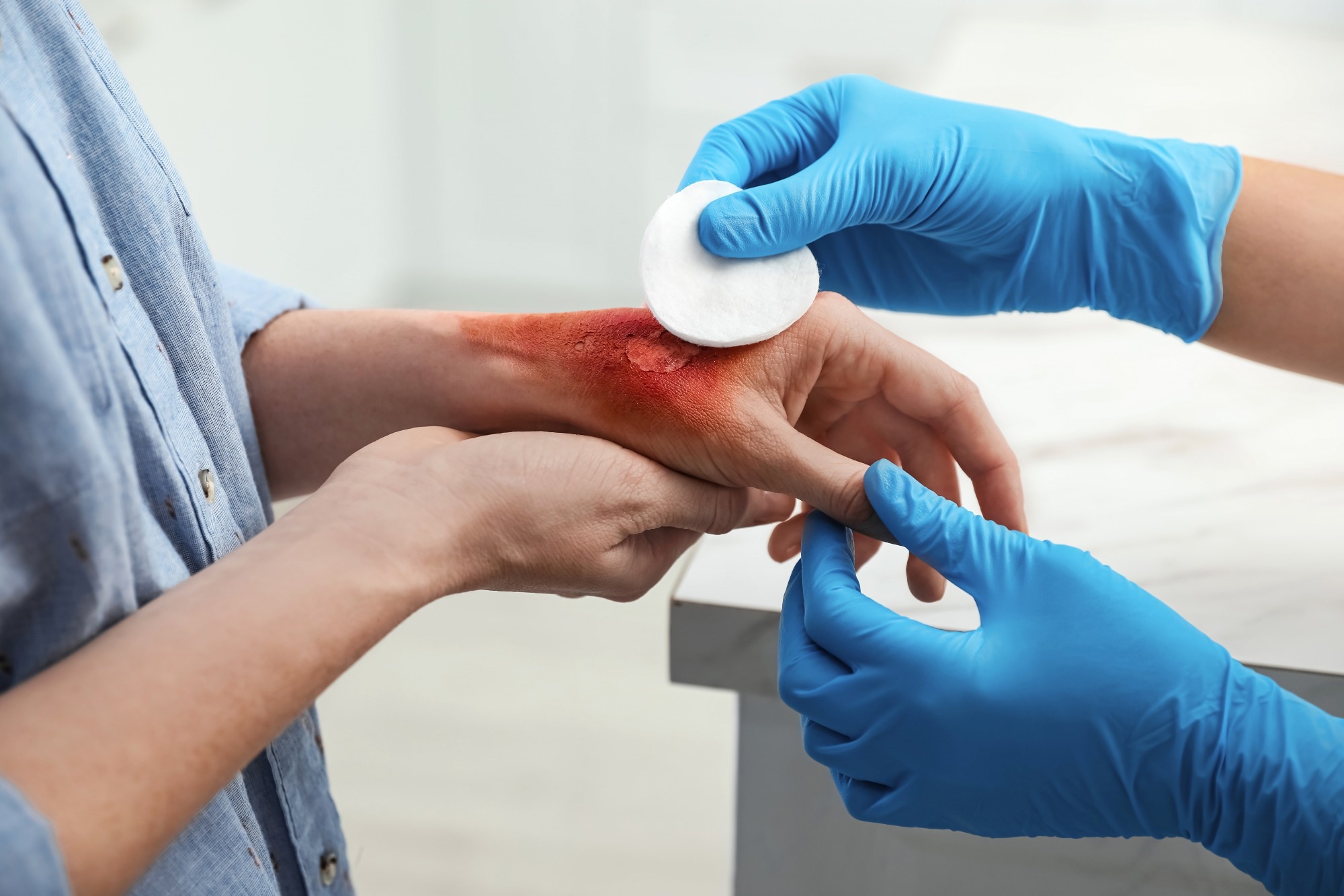 Study: Advancing Burn Patient Care: AI-Driven Prognosis Models. Image credit: New Africa/Shutterstock