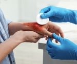 Advancing Burn Patient Care: AI-Driven Prognosis Models