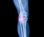 A Meta-analysis of AI's Diagnostic Accuracy in Fracture Detection