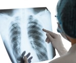 AI and Smartphone Technology: Transforming Pulmonary Inflammation Diagnosis