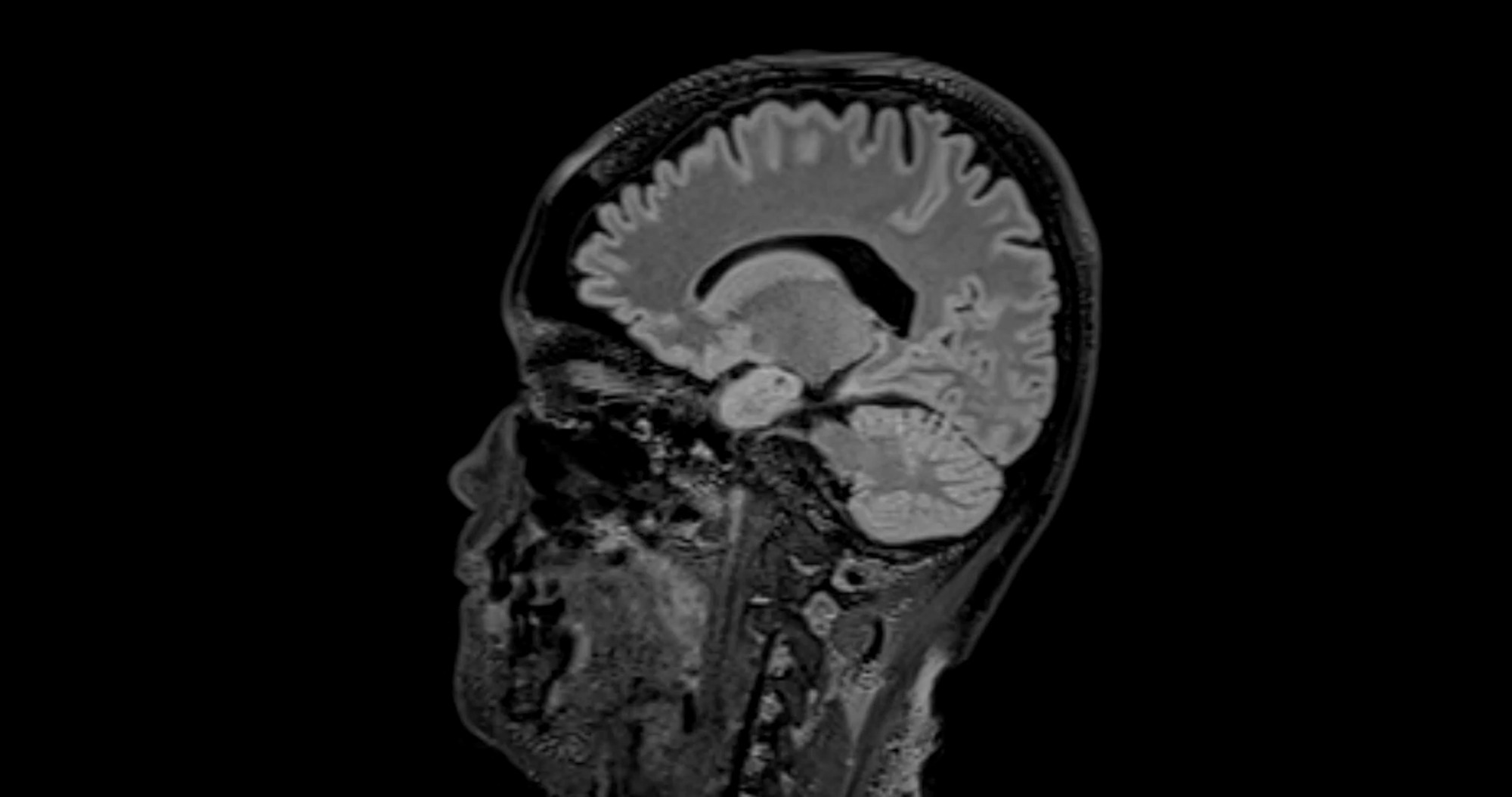 Study: High-Accuracy Brain Tumor Detection through Deep Transfer Learning. Image credit:  Radiological imaging/Shutterstock