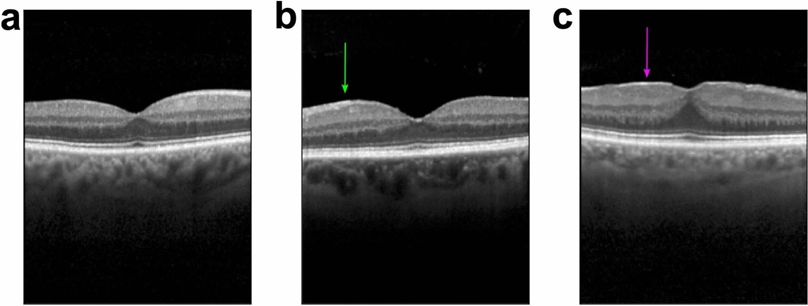 Exemplary optical coherence tomography images of the fovea. (a) No epiretinal membrane (ERM). (b) Small ERM (100–1000 µm) (green arrow). (c) Large ERM (> 1000 µm) (magenta arrow). https://www.nature.com/articles/s41598-024-57798-1