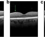 Automated Detection of Epiretinal Membranes in OCT Scans