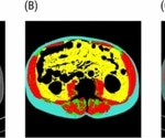 AI Analysis of Body Composition Predicts Survival After Aortic Valve Implantation