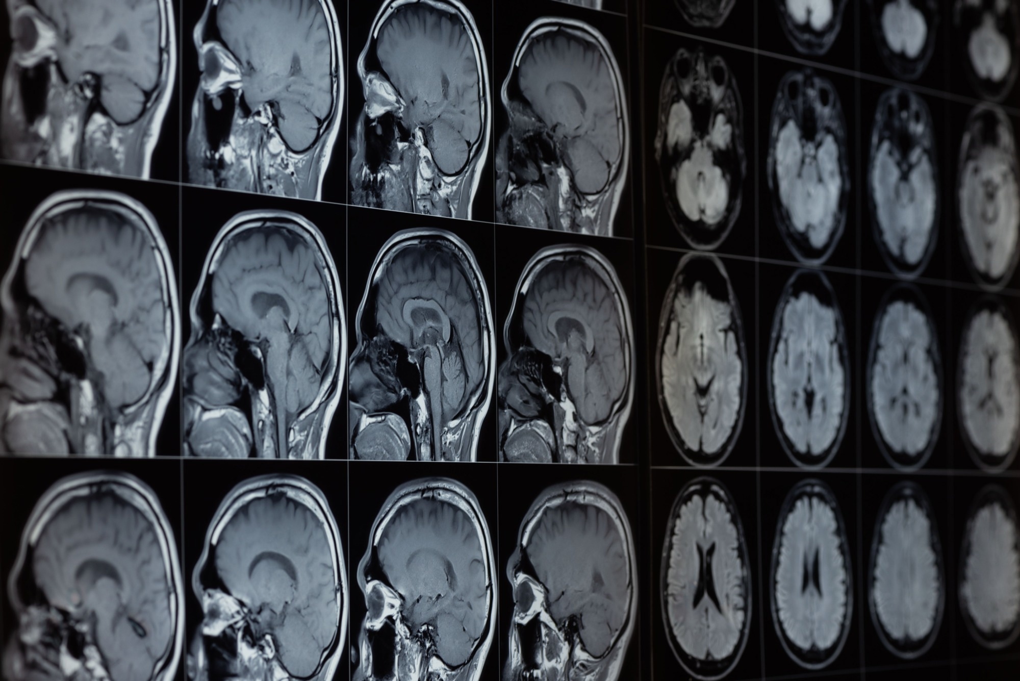Research: Machine learning prediction of brain metastasis invasion pattern on brain magnetic resonance imaging scans. ​​​​​​​Image Credit: Teeradej / Shutterstock