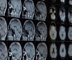 AI Detects Cancer Invasion Patterns, Revolutionizing Brain Metastasis Treatment