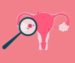 AI Chatbots Give Basic Endometriosis Info but Lack Medical Accuracy