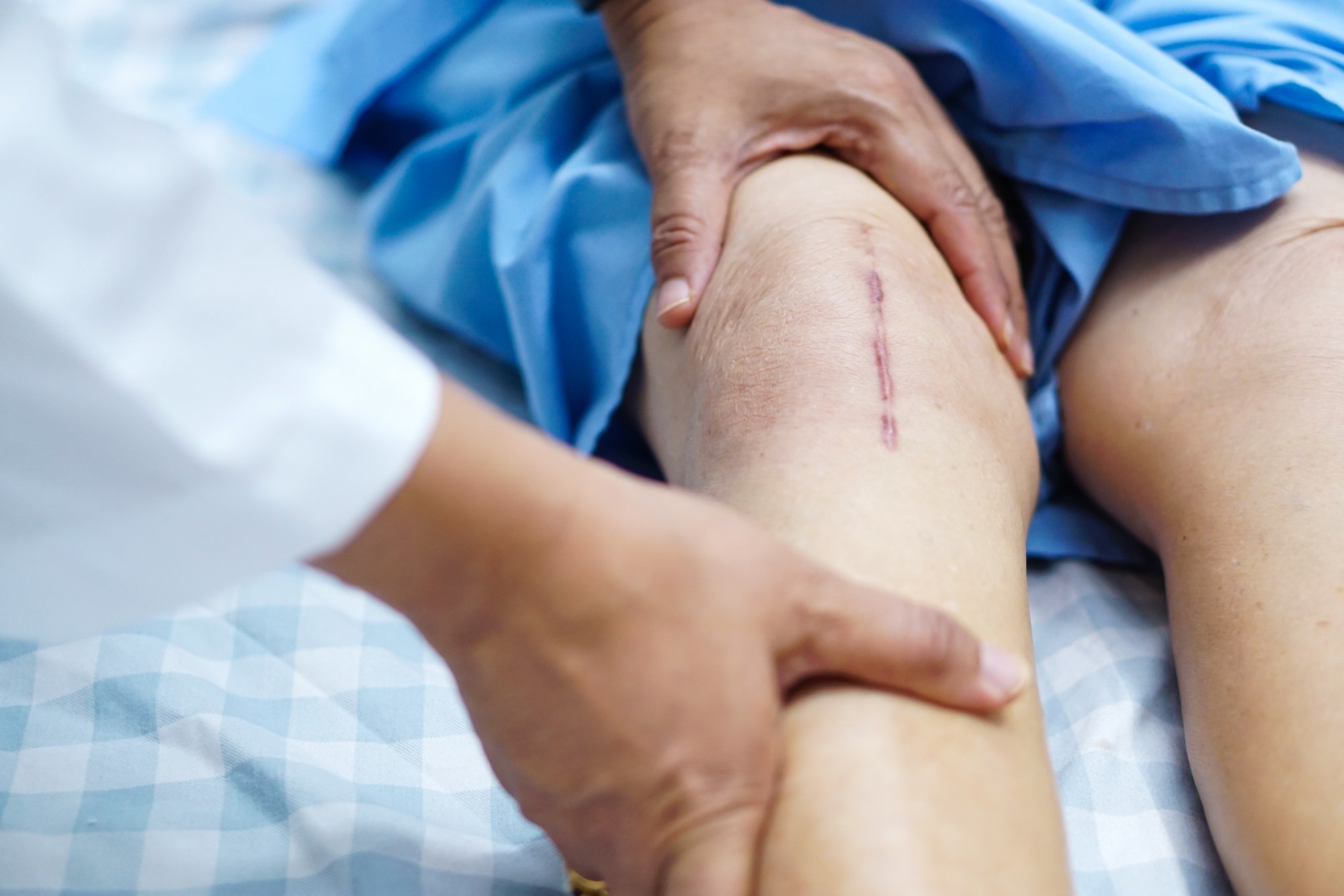 ​​​​​​​2025 Knee Society Award: The John N. Insall Award: Functional Versus Mechanical Alignment in Total Knee Arthroplasty: A Randomized Controlled Trial. ​​​​​​​Image Credit: sasirin pamai / Shutterstock