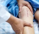 AI-Powered Knee Surgery Delivers Better Results for Patients With Bowed Legs