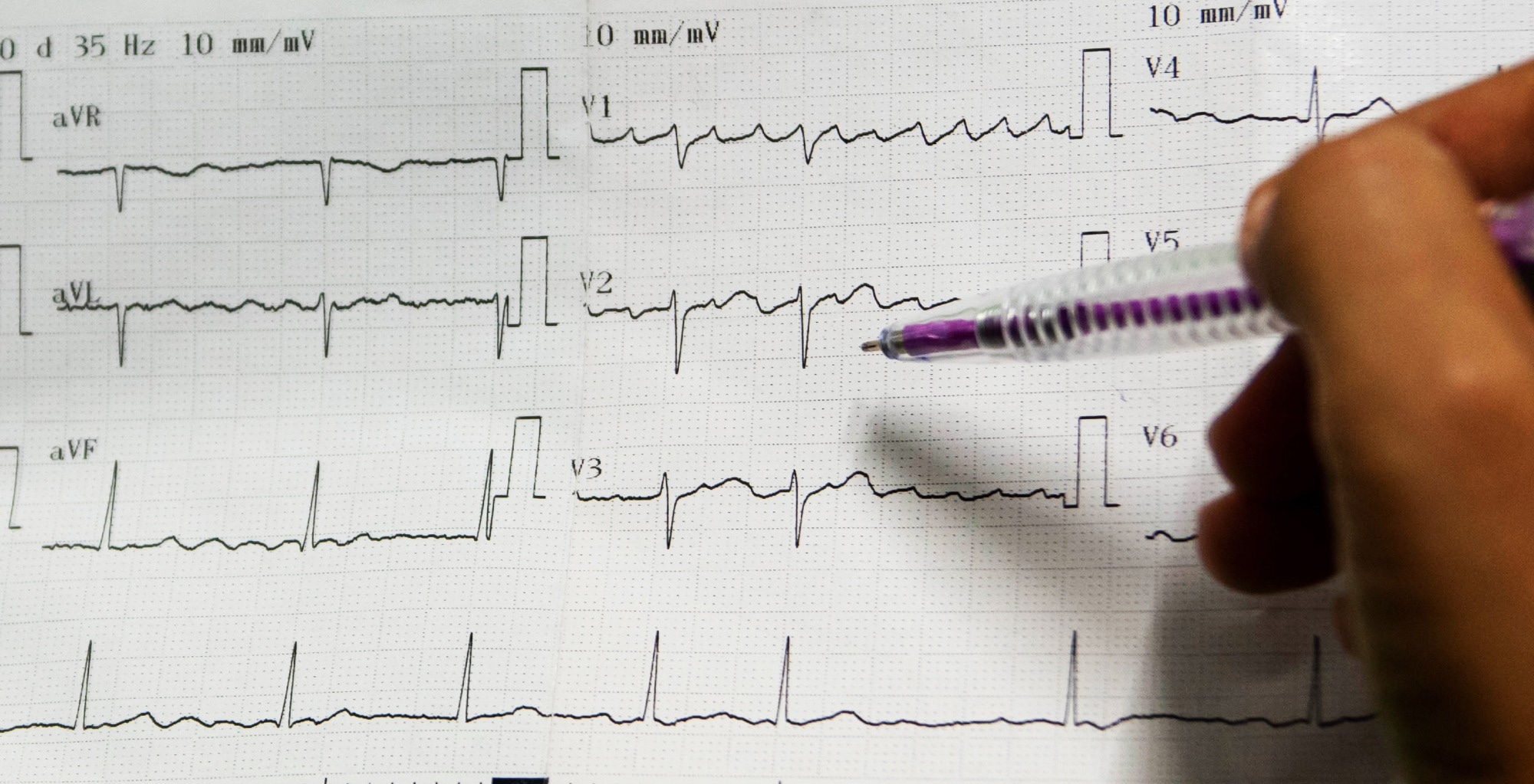 Research: Synthetic generation of cardiac tissue motion from surface electrocardiograms. Image Credit: tnkorn yangaun / Shutterstock