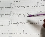 AI Turns ECG Into Heart Motion Maps, Boosting Early Detection of Cardiac Disease