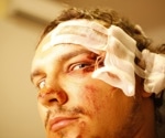 AI Predicts Post-Concussion Injury Risk With 95% Accuracy, Transforming Athlete Safety