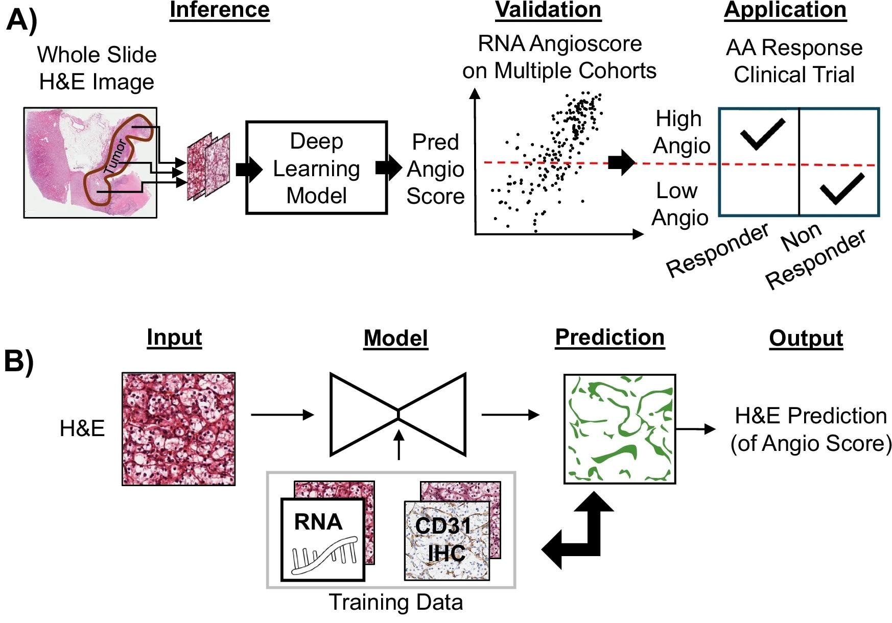 A Schematic outlining the H&E DL Model development, validation and practical application of the model. The model predicts Angioscores directly from an H&E-stained slide and is validated against the RNA-based Angioscore using multiple independent datasets. The validated model is applied to independent, previously unseen, clinical datasets where its predicted Angioscore is correlated with response to antiangiogenic (AA) therapy. B H&E DL Model is an interpretable machine learning model to predict Angioscore from H&E images. Given an input H&E image, the model predicts a vascular mask (green), and the proportion of positive pixels is the output H&E-based Angioscore. Training data consists of two datasets with H&E images matched with RNA-based Angioscores and CD31 IHC (basis of the vascular mask), providing the target ground truth. The model is trained to predict the vascular mask matching the CD31 and the RNA-based Angioscore (see Supplementary Fig 1 and methods for details).