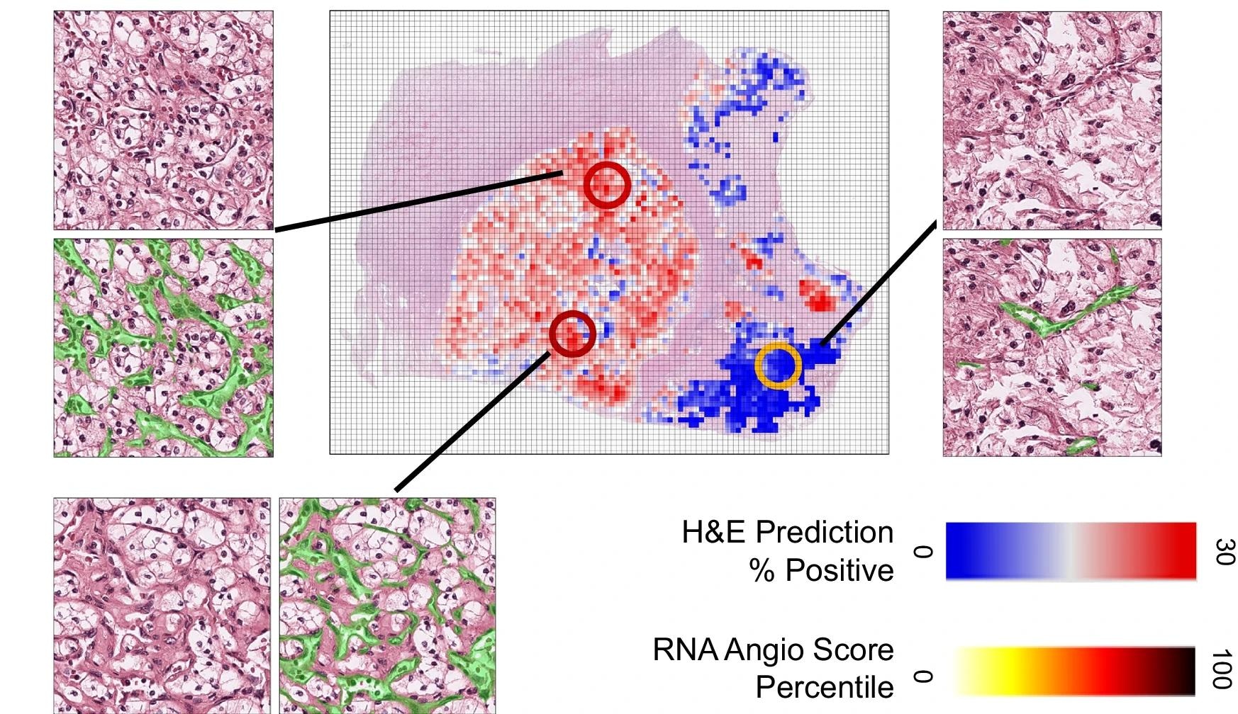 Illustration of the model output on a ccRCC case with intra-slide heterogeneity and available multiregional RNA sequencing data. The central plot shows the model H&E Angioscore (blue-white-red colormap) applied to all tumor areas on the slide. To contrast against the output from patch level models (e.g., based on MIL), we calculated a local average of the percentage positive vascular mask prediction within a 416 x 416px grid, which show a far lower level of explainability than the pixel level vascular masks shown alongside. Three areas (circles) are marked where we had the ground truth RNA-based Angioscores (circle colors in yellow, red colormap). There is a broad qualitative agreement in the amount of vasculature and the H&E- based and RNA-based Angioscores, and both capture ITH which would have been missed by the standard slide-level bulk sequencing approaches.