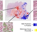 AI Predicts Kidney Cancer Drug Response Using Routine Pathology Slides