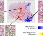 AI Predicts Kidney Cancer Drug Response Using Routine Pathology Slides