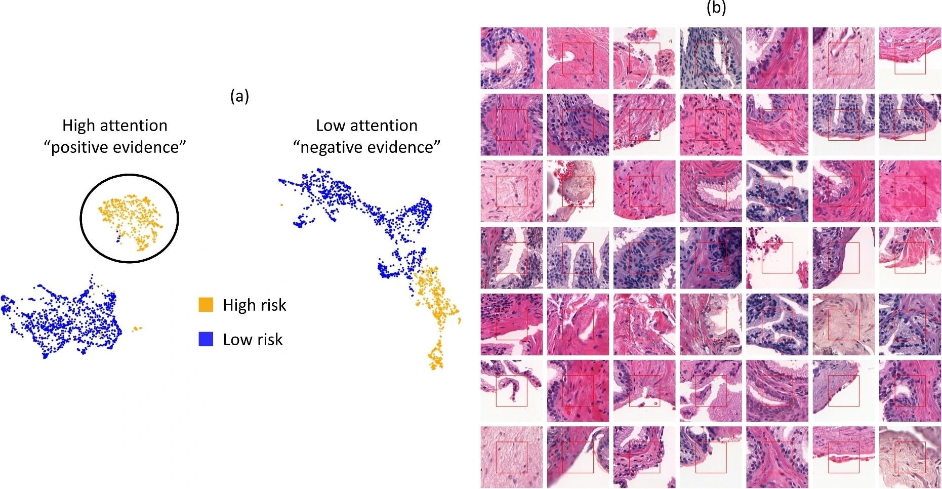 (a) UMAP space of the 20 most and least attended tiles from the correctly classified slides in the test set. (b) Sample of the most attended morphologies that drove the classification, the positive evidence for being high risk. The red square in the middle is the actual tile size, the rest is shown for context.