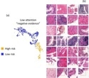 AI Detects Hidden Prostate Cancer Missed By Pathologists In Routine Biopsies