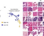 AI Detects Hidden Prostate Cancer Missed By Pathologists In Routine Biopsies