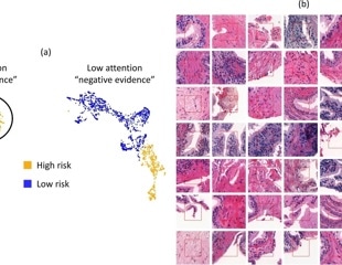 AI Detects Hidden Prostate Cancer Missed By Pathologists In Routine Biopsies
