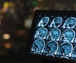 Unlocking MS Secrets: AI-Powered MRI Analysis Revolutionizes Diagnosis and Treatment